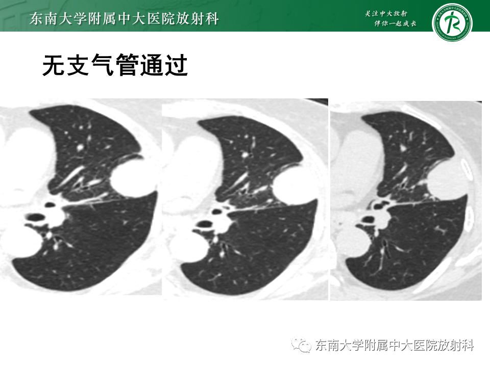 影像PPT - 【PPT】胸部孤立性纤维性肿瘤-17 影像PPT - 【PPT】胸部孤立性纤维性肿瘤-17