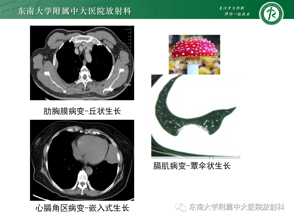 影像PPT - 【PPT】胸部孤立性纤维性肿瘤-19 影像PPT - 【PPT】胸部孤立性纤维性肿瘤-19