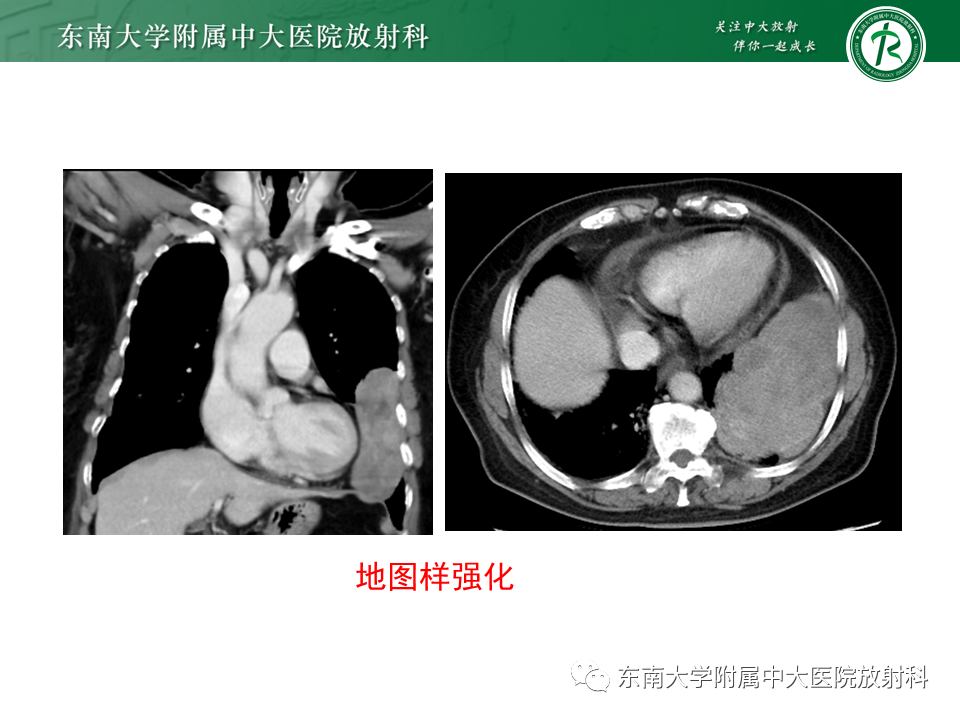影像PPT - 【PPT】胸部孤立性纤维性肿瘤-22 影像PPT - 【PPT】胸部孤立性纤维性肿瘤-22