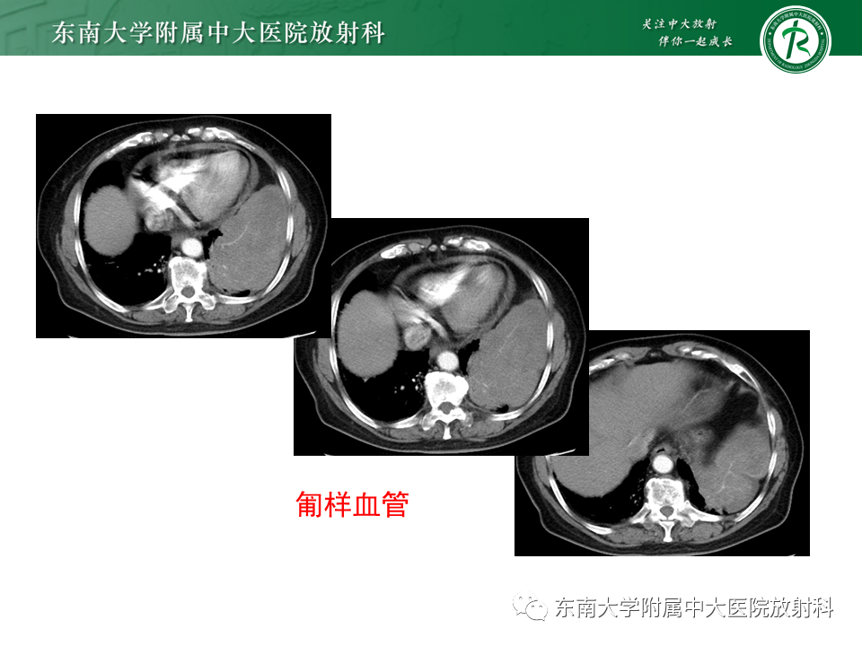 影像PPT - 【PPT】胸部孤立性纤维性肿瘤-23 影像PPT - 【PPT】胸部孤立性纤维性肿瘤-23