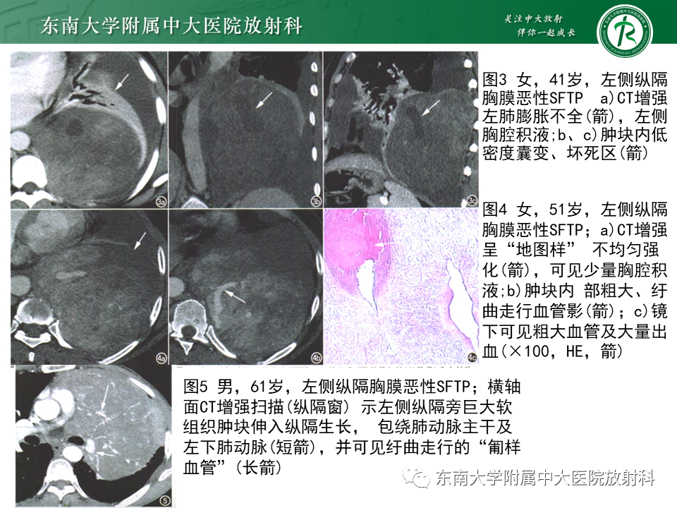 影像PPT - 【PPT】胸部孤立性纤维性肿瘤-25 影像PPT - 【PPT】胸部孤立性纤维性肿瘤-25