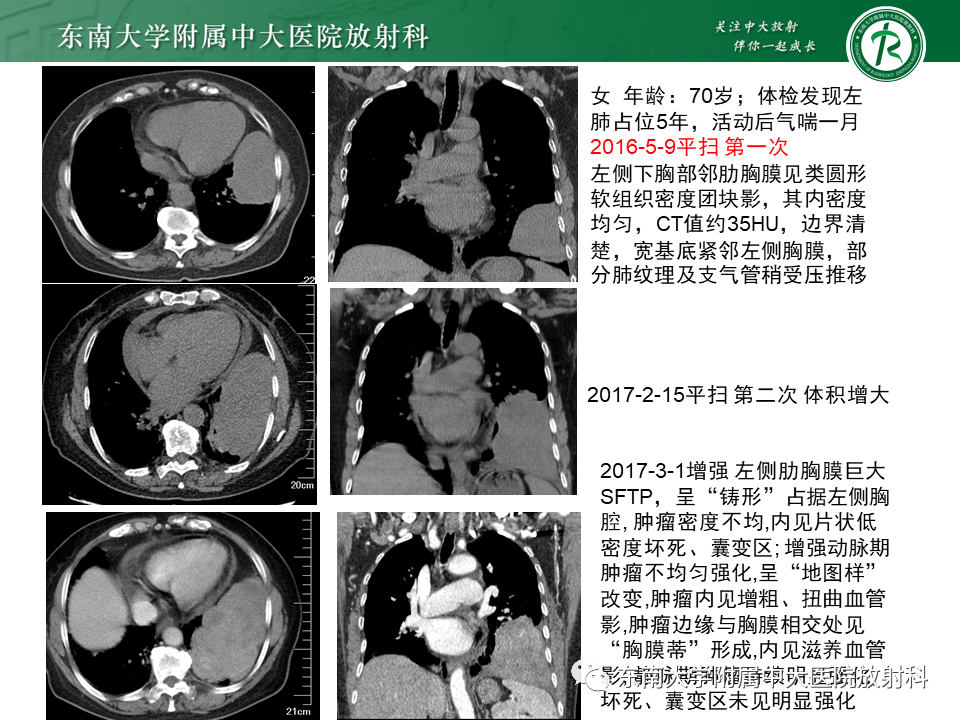 影像PPT - 【PPT】胸部孤立性纤维性肿瘤-26 影像PPT - 【PPT】胸部孤立性纤维性肿瘤-26