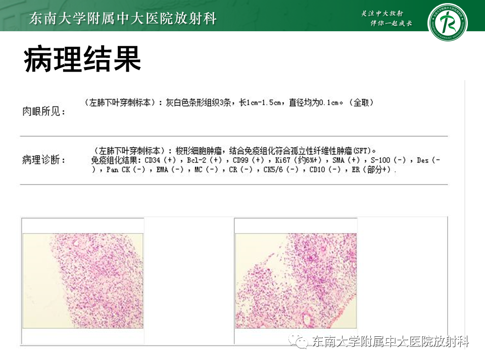 影像PPT - 【PPT】胸部孤立性纤维性肿瘤-27 影像PPT - 【PPT】胸部孤立性纤维性肿瘤-27