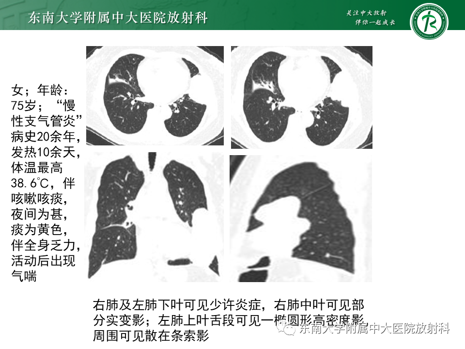 影像PPT - 【PPT】胸部孤立性纤维性肿瘤-28 影像PPT - 【PPT】胸部孤立性纤维性肿瘤-28