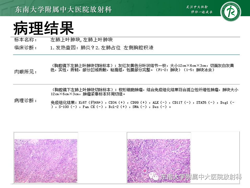 影像PPT - 【PPT】胸部孤立性纤维性肿瘤-30 影像PPT - 【PPT】胸部孤立性纤维性肿瘤-30