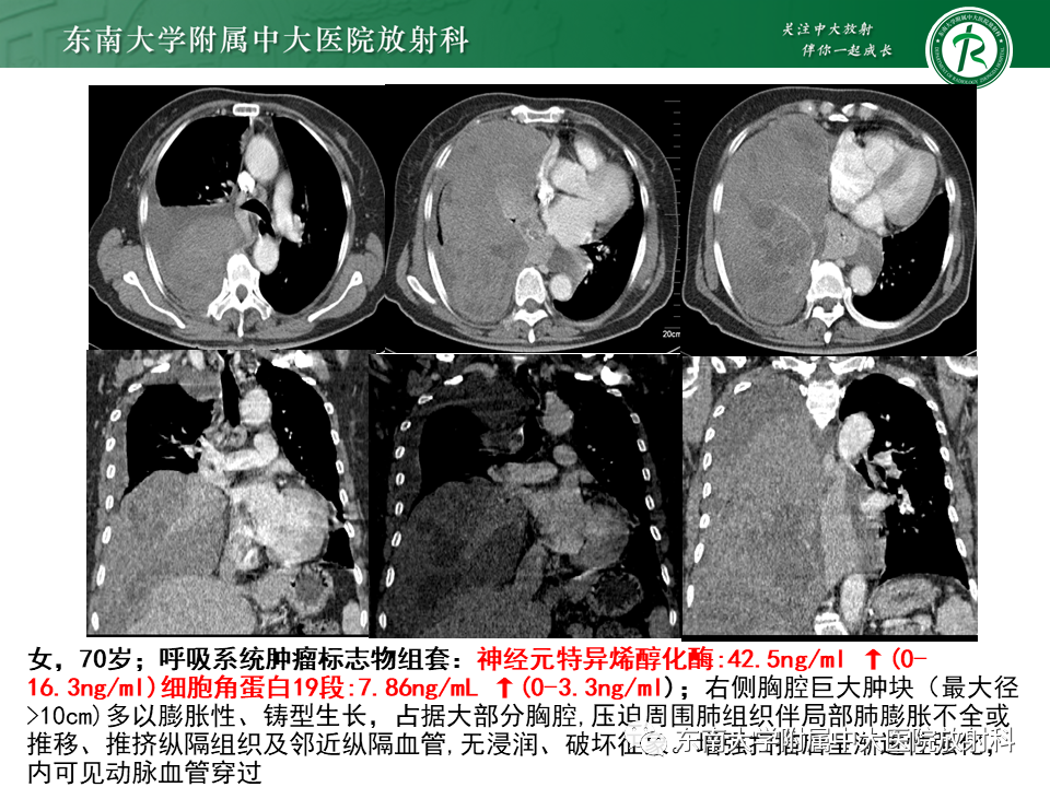 影像PPT - 【PPT】胸部孤立性纤维性肿瘤-31 影像PPT - 【PPT】胸部孤立性纤维性肿瘤-31