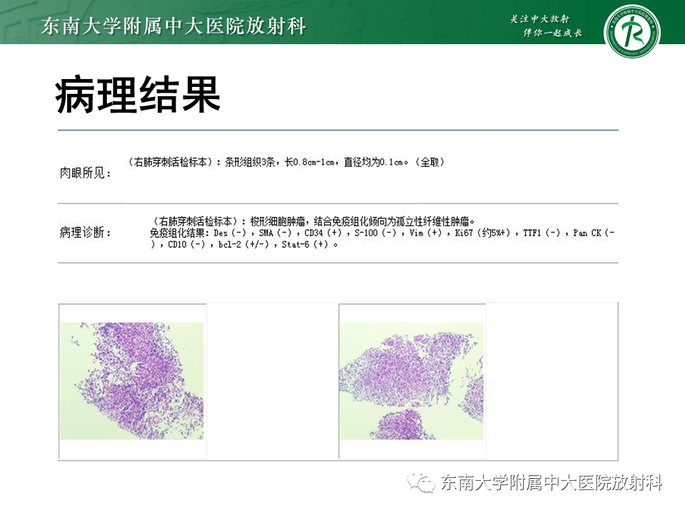 影像PPT - 【PPT】胸部孤立性纤维性肿瘤-32 影像PPT - 【PPT】胸部孤立性纤维性肿瘤-32