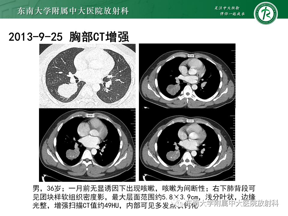 影像PPT - 【PPT】胸部孤立性纤维性肿瘤-34 影像PPT - 【PPT】胸部孤立性纤维性肿瘤-34