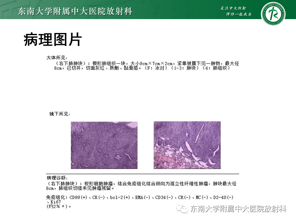 影像PPT - 【PPT】胸部孤立性纤维性肿瘤-35 影像PPT - 【PPT】胸部孤立性纤维性肿瘤-35