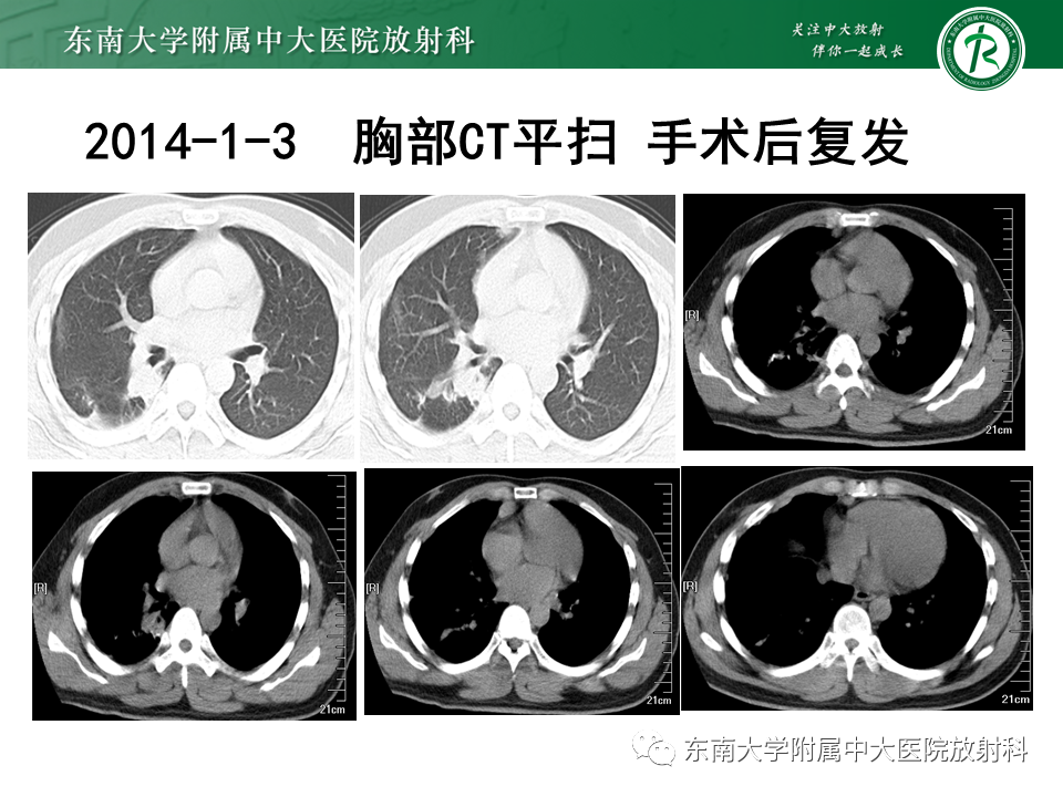 影像PPT - 【PPT】胸部孤立性纤维性肿瘤-36 影像PPT - 【PPT】胸部孤立性纤维性肿瘤-36