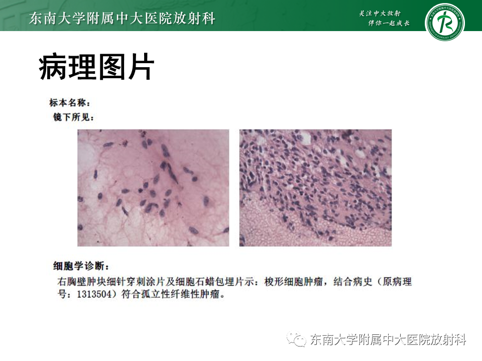 影像PPT - 【PPT】胸部孤立性纤维性肿瘤-38 影像PPT - 【PPT】胸部孤立性纤维性肿瘤-38