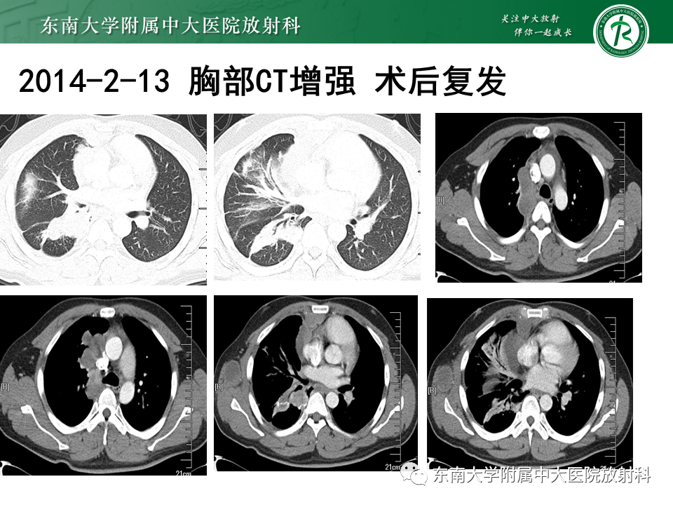 影像PPT - 【PPT】胸部孤立性纤维性肿瘤-37 影像PPT - 【PPT】胸部孤立性纤维性肿瘤-37