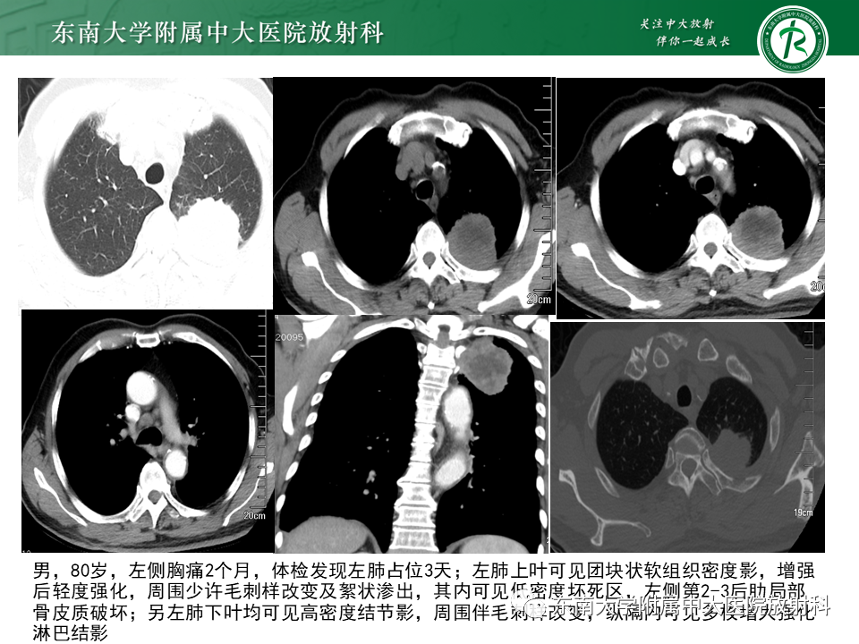 影像PPT - 【PPT】胸部孤立性纤维性肿瘤-41 影像PPT - 【PPT】胸部孤立性纤维性肿瘤-41