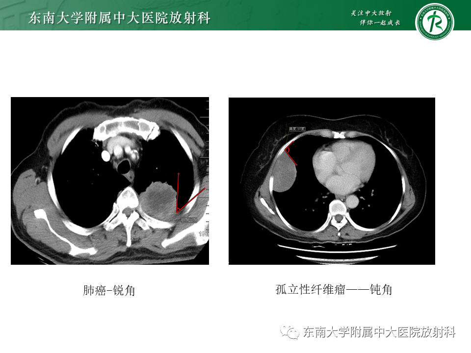 影像PPT - 【PPT】胸部孤立性纤维性肿瘤-42 影像PPT - 【PPT】胸部孤立性纤维性肿瘤-42