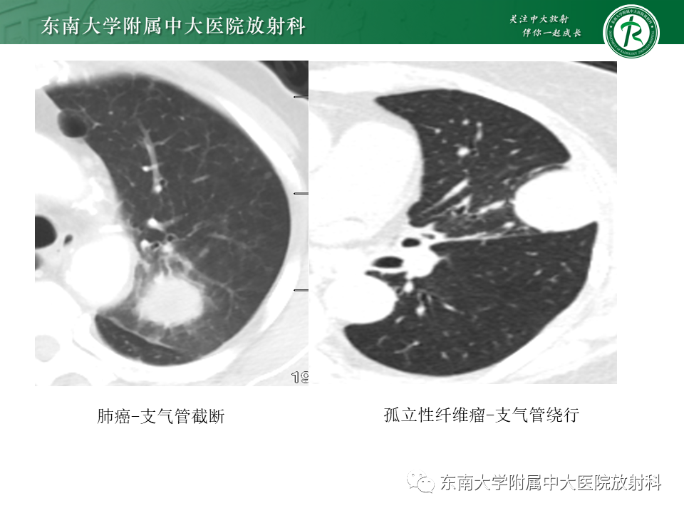 影像PPT - 【PPT】胸部孤立性纤维性肿瘤-43 影像PPT - 【PPT】胸部孤立性纤维性肿瘤-43