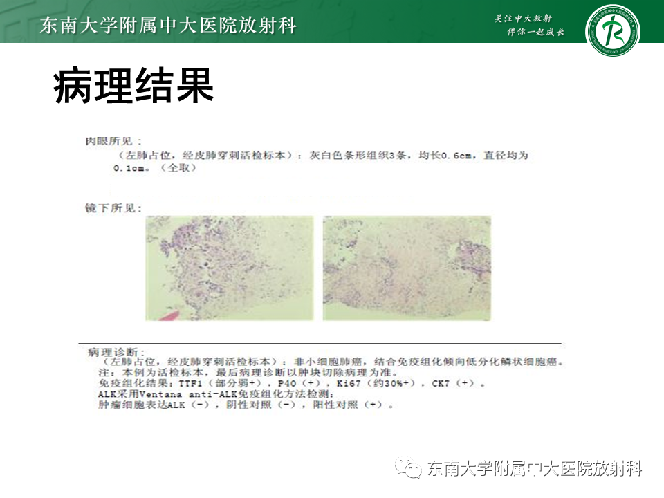 影像PPT - 【PPT】胸部孤立性纤维性肿瘤-44 影像PPT - 【PPT】胸部孤立性纤维性肿瘤-44