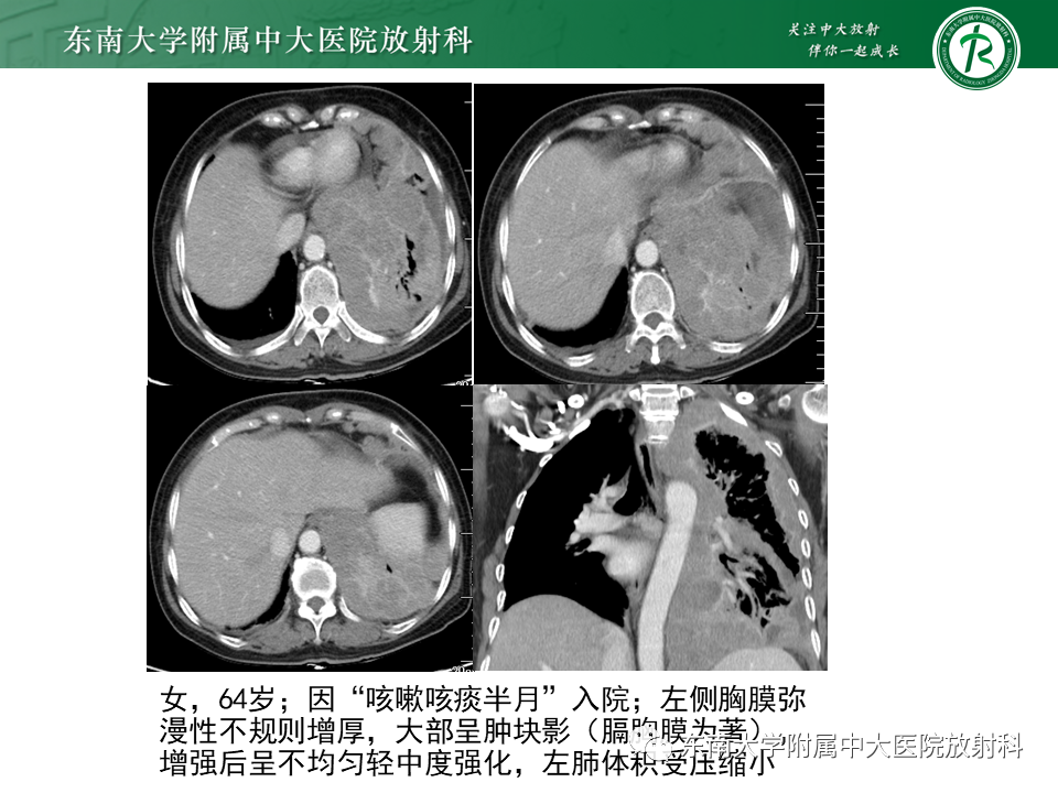 影像PPT - 【PPT】胸部孤立性纤维性肿瘤-46 影像PPT - 【PPT】胸部孤立性纤维性肿瘤-46