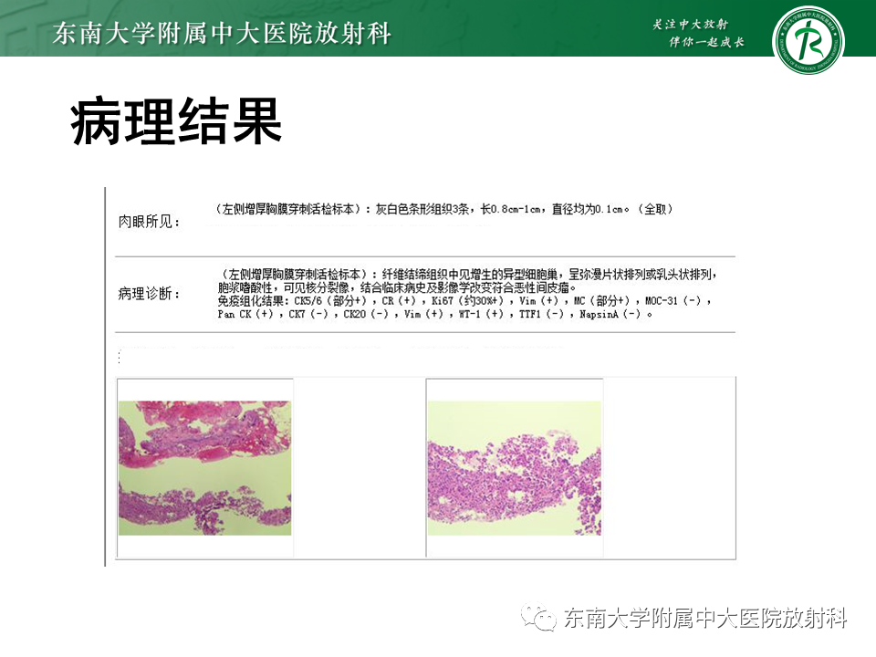 影像PPT - 【PPT】胸部孤立性纤维性肿瘤-47 影像PPT - 【PPT】胸部孤立性纤维性肿瘤-47