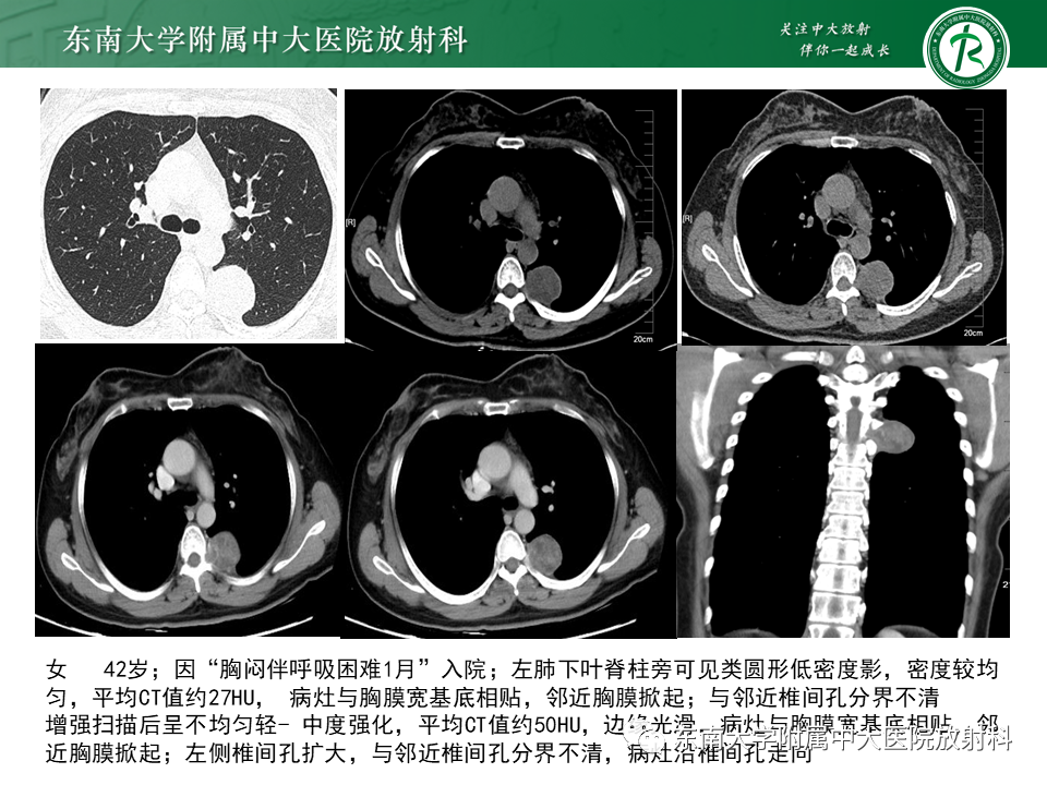 影像PPT - 【PPT】胸部孤立性纤维性肿瘤-49 影像PPT - 【PPT】胸部孤立性纤维性肿瘤-49