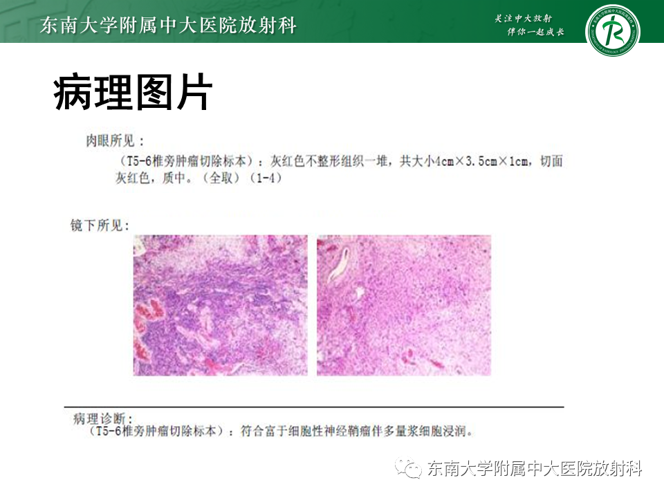 影像PPT - 【PPT】胸部孤立性纤维性肿瘤-50 影像PPT - 【PPT】胸部孤立性纤维性肿瘤-50