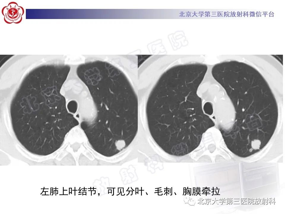 影像PPT - 【PPT】细支气管腺瘤-3