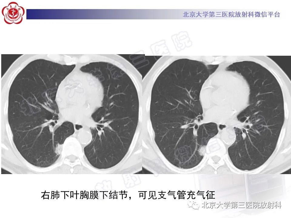 影像PPT - 【PPT】细支气管腺瘤-5