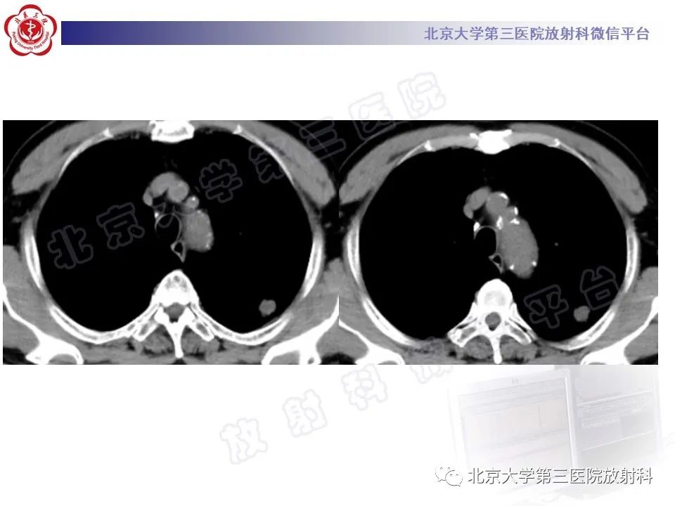 影像PPT - 【PPT】细支气管腺瘤-4