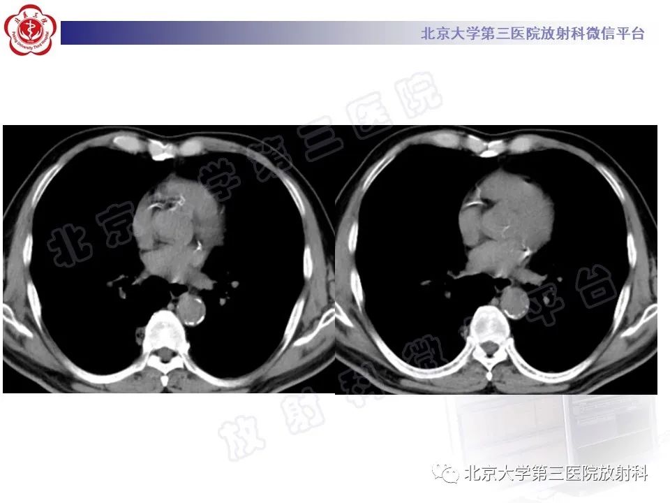 影像PPT - 【PPT】细支气管腺瘤-6