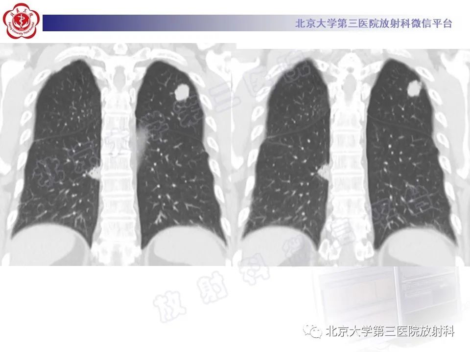 影像PPT - 【PPT】细支气管腺瘤-7