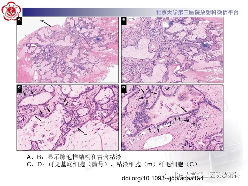 影像PPT - 【PPT】细支气管腺瘤-18