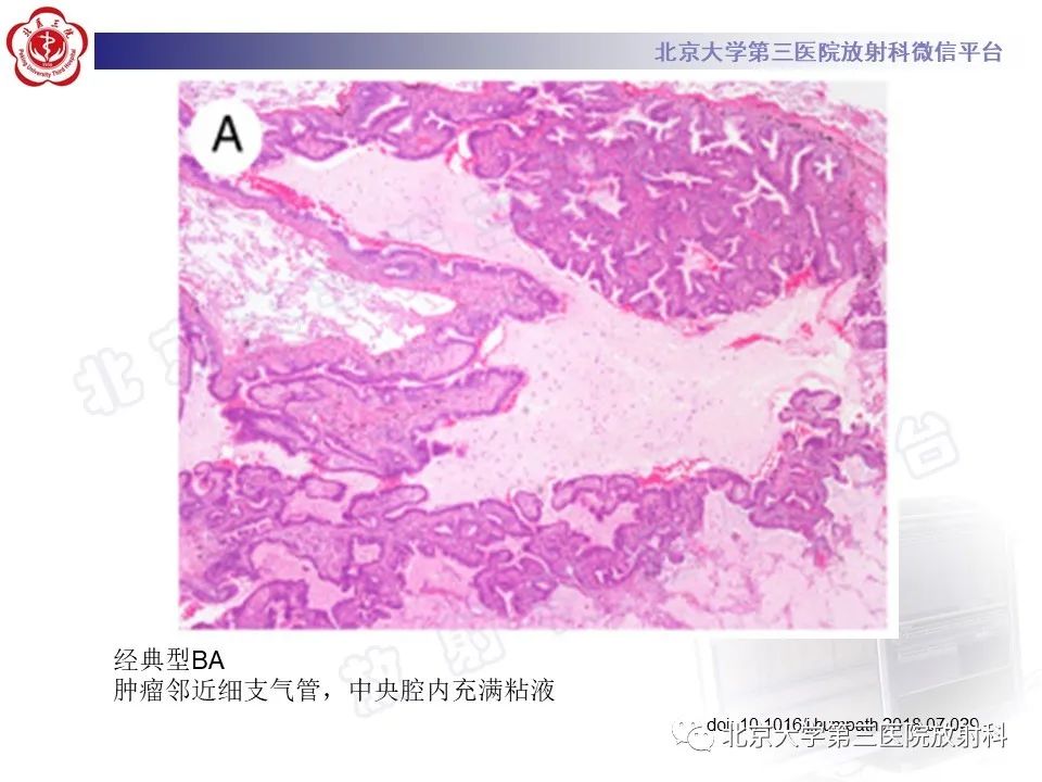 影像PPT - 【PPT】细支气管腺瘤-20