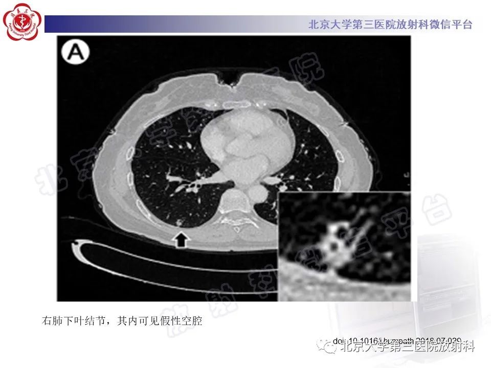 影像PPT - 【PPT】细支气管腺瘤-27