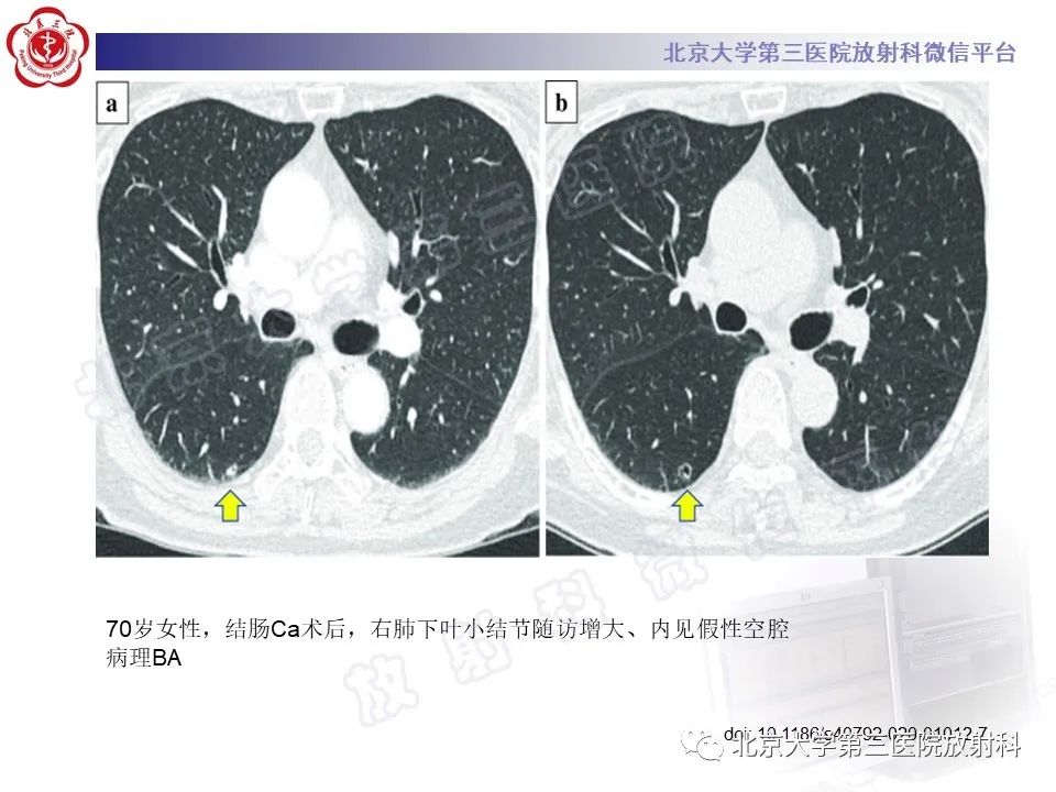影像PPT - 【PPT】细支气管腺瘤-28