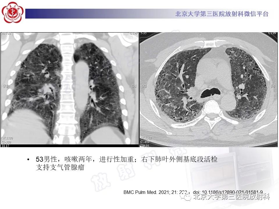 影像PPT - 【PPT】细支气管腺瘤-30