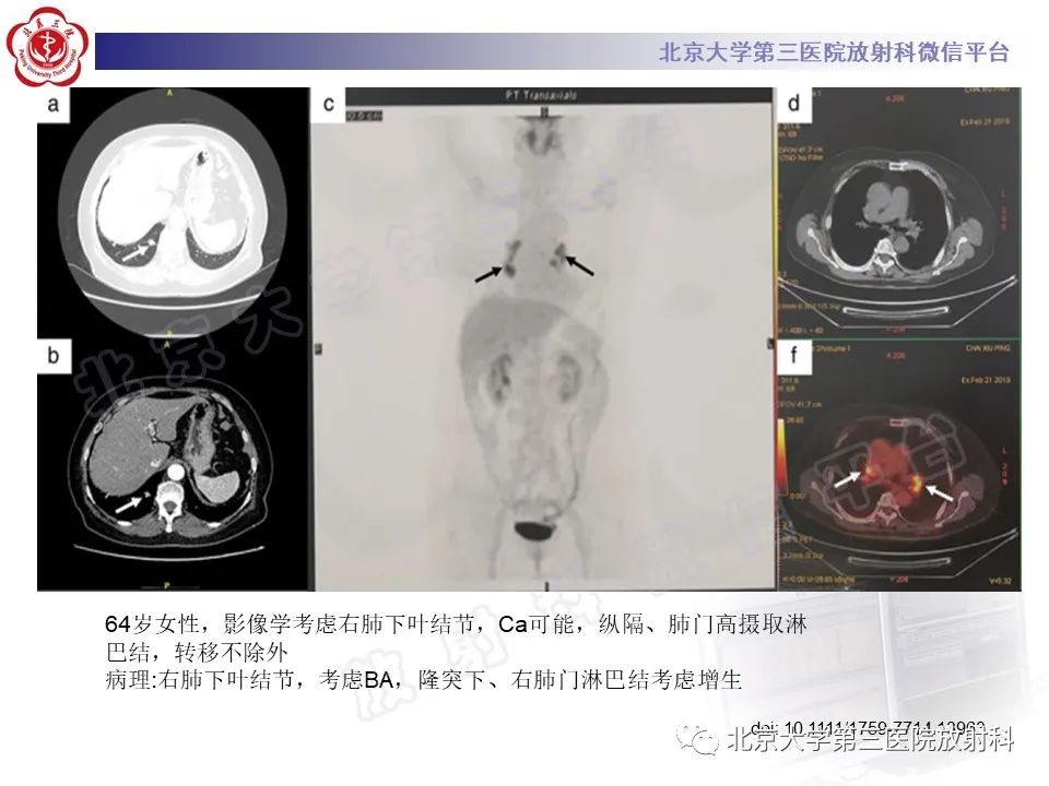 影像PPT - 【PPT】细支气管腺瘤-31