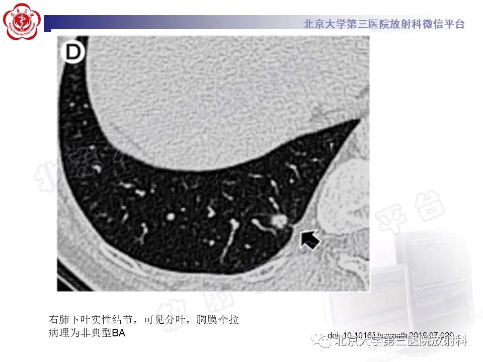 影像PPT - 【PPT】细支气管腺瘤-32