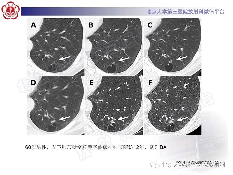 影像PPT - 【PPT】细支气管腺瘤-33