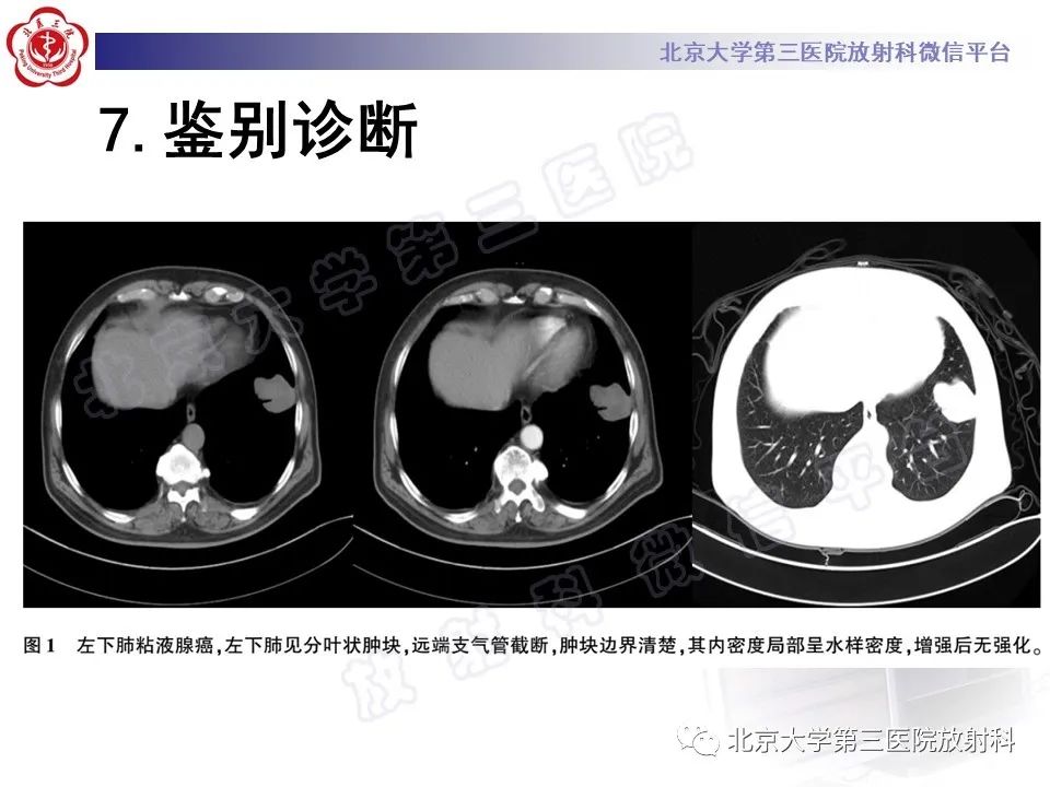影像PPT - 【PPT】细支气管腺瘤-35