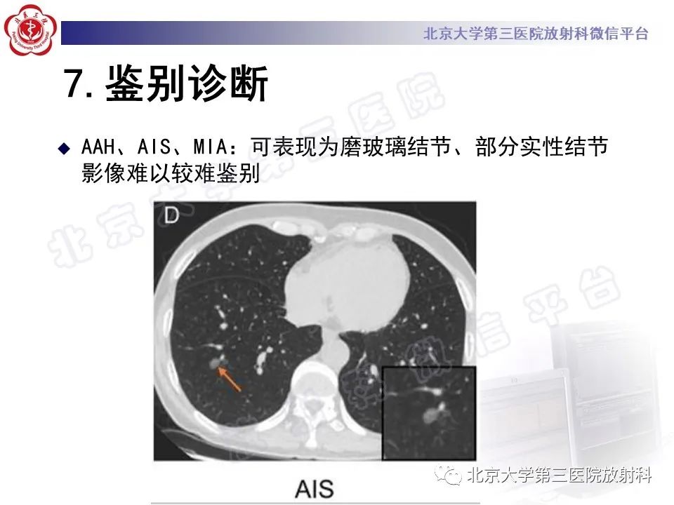 影像PPT - 【PPT】细支气管腺瘤-36