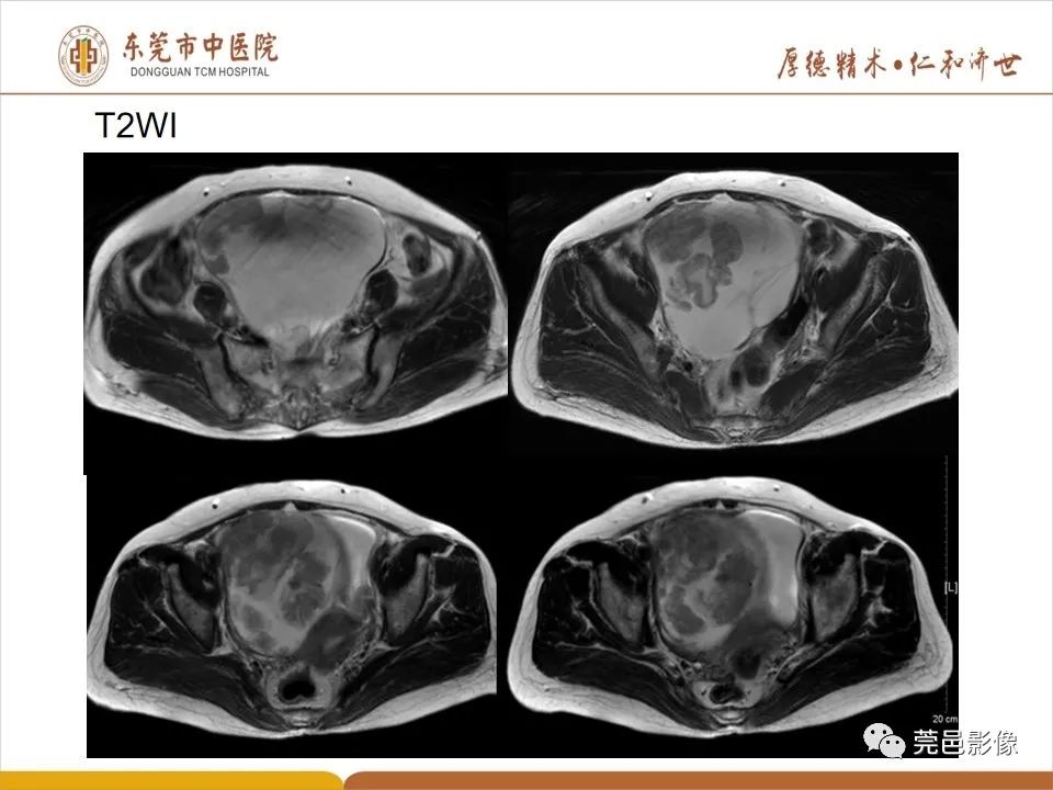 影像PPT - 【PPT】卵巢透明细胞癌CT/MRI诊断及鉴别诊断-5