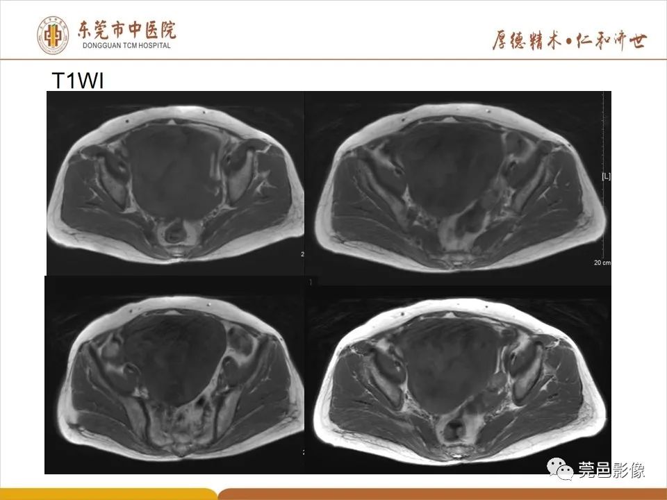 影像PPT - 【PPT】卵巢透明细胞癌CT/MRI诊断及鉴别诊断-6