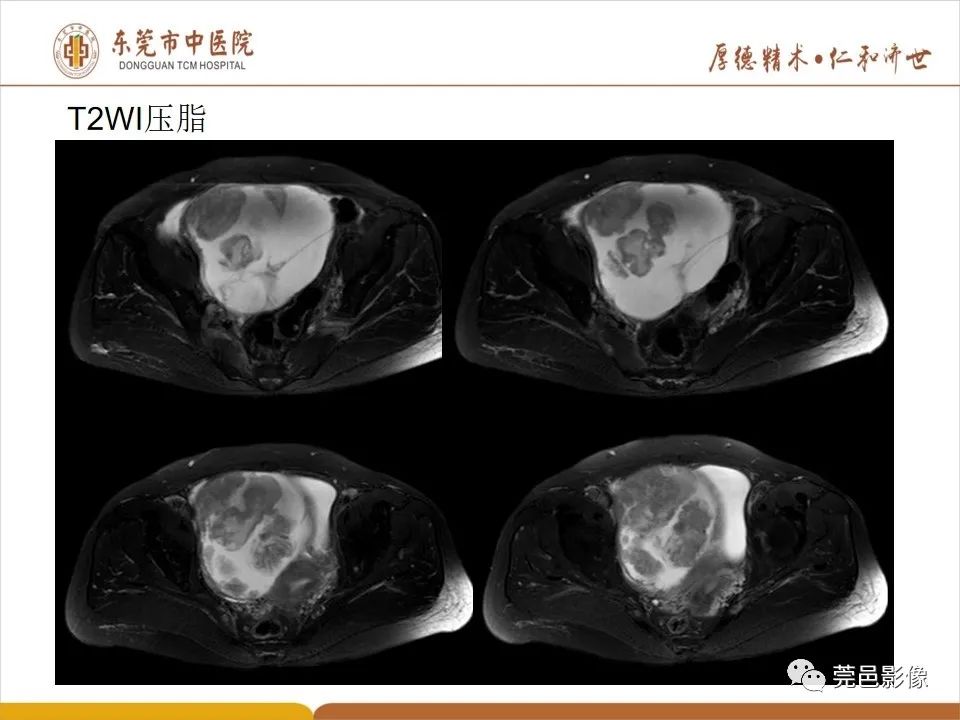 影像PPT - 【PPT】卵巢透明细胞癌CT/MRI诊断及鉴别诊断-7