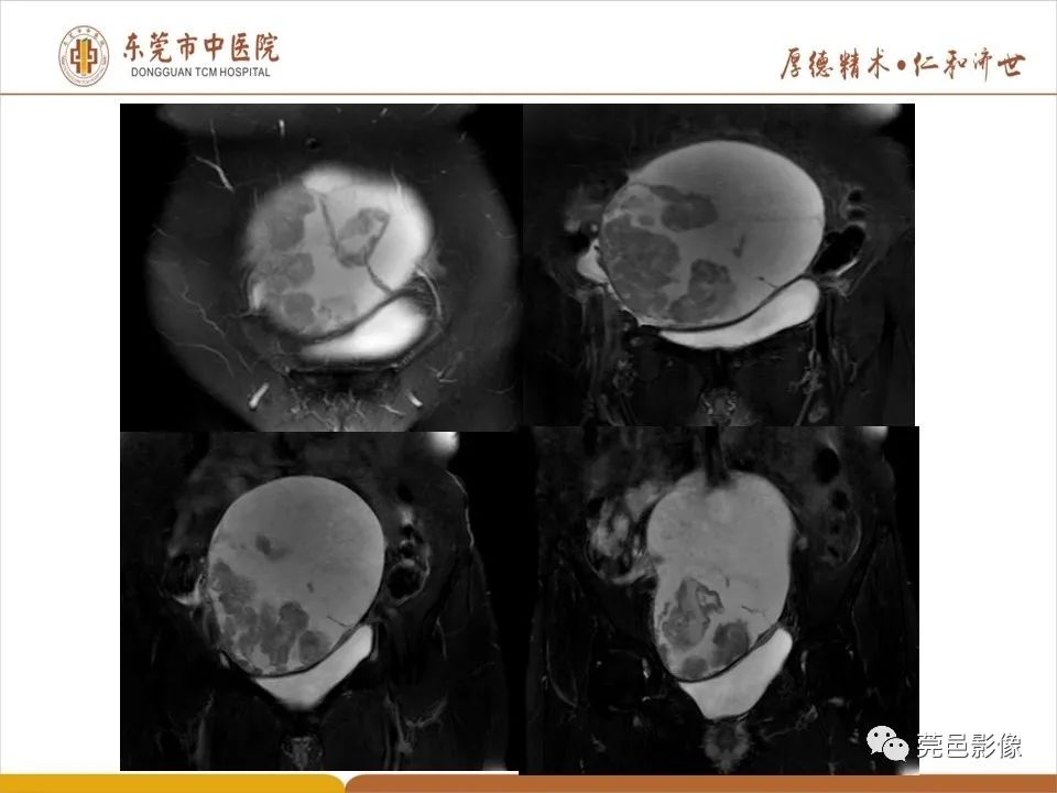 影像PPT - 【PPT】卵巢透明细胞癌CT/MRI诊断及鉴别诊断-8