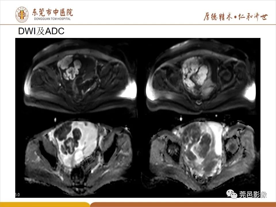 影像PPT - 【PPT】卵巢透明细胞癌CT/MRI诊断及鉴别诊断-9