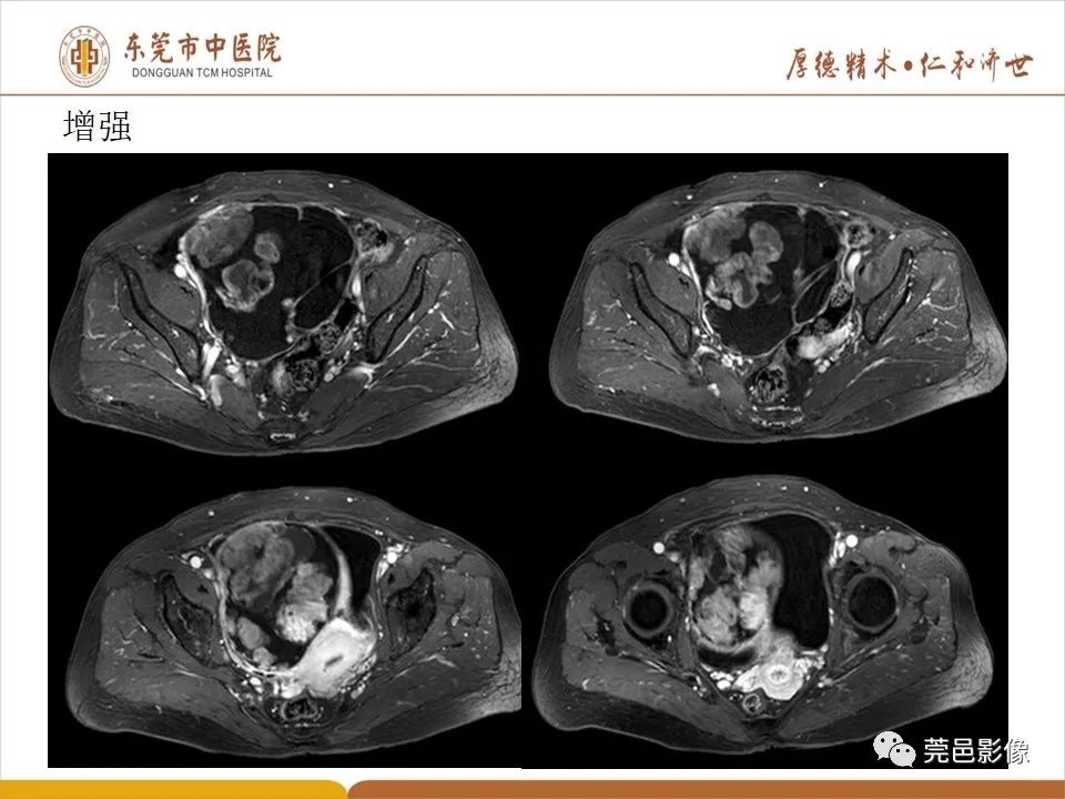 影像PPT - 【PPT】卵巢透明细胞癌CT/MRI诊断及鉴别诊断-10