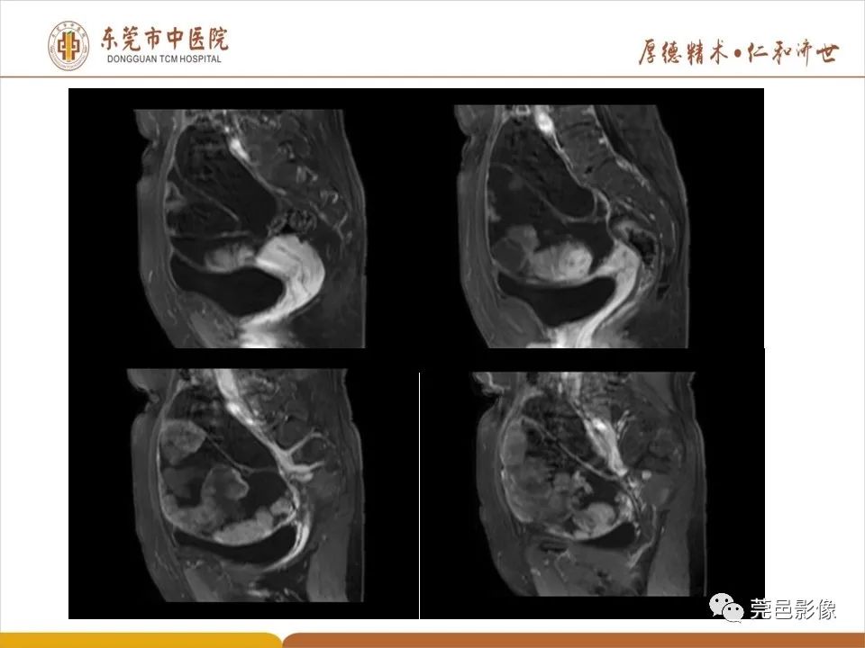 影像PPT - 【PPT】卵巢透明细胞癌CT/MRI诊断及鉴别诊断-11