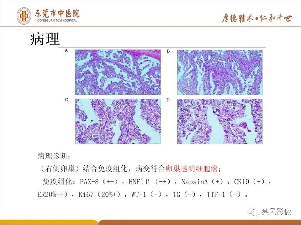 影像PPT - 【PPT】卵巢透明细胞癌CT/MRI诊断及鉴别诊断-13