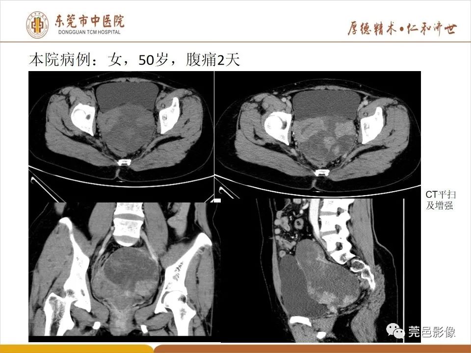 影像PPT - 【PPT】卵巢透明细胞癌CT/MRI诊断及鉴别诊断-21