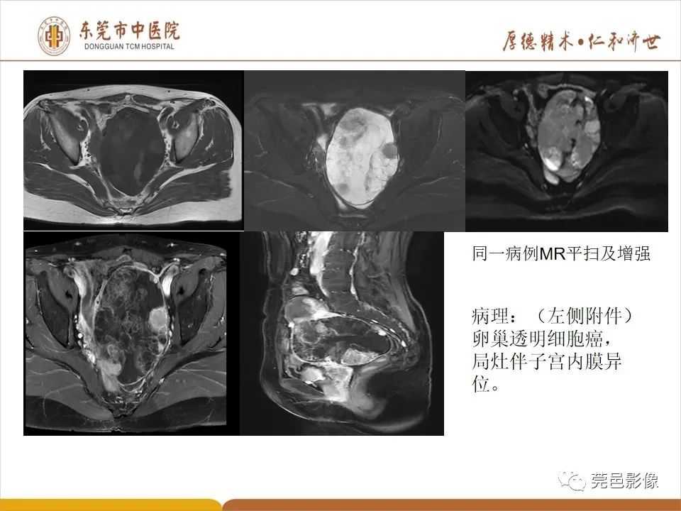 影像PPT - 【PPT】卵巢透明细胞癌CT/MRI诊断及鉴别诊断-22