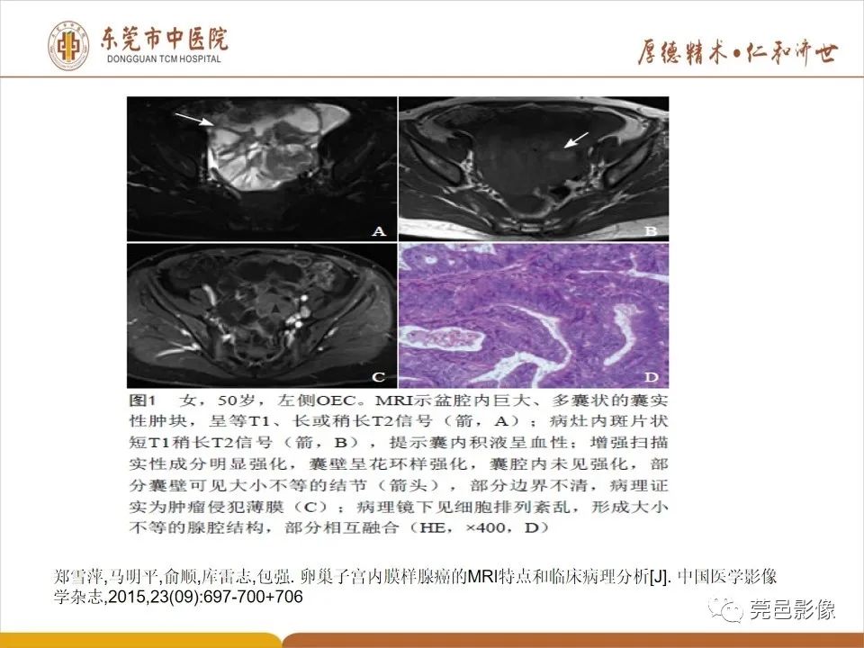 影像PPT - 【PPT】卵巢透明细胞癌CT/MRI诊断及鉴别诊断-28